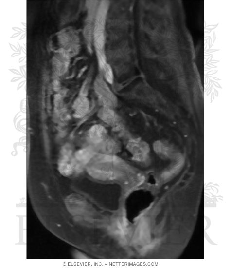 Median T1-Weighted MRI of Female Pelvis