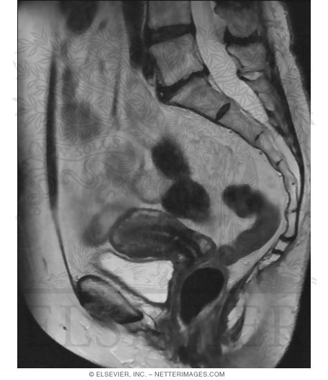 Median T2-Weighted MRI of Female Pelvis