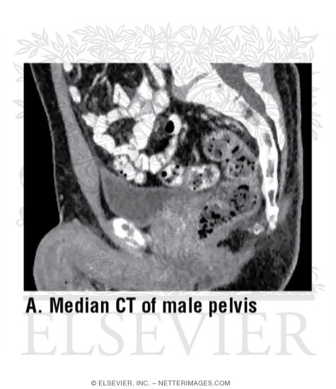 Median CT of Male Pelvis