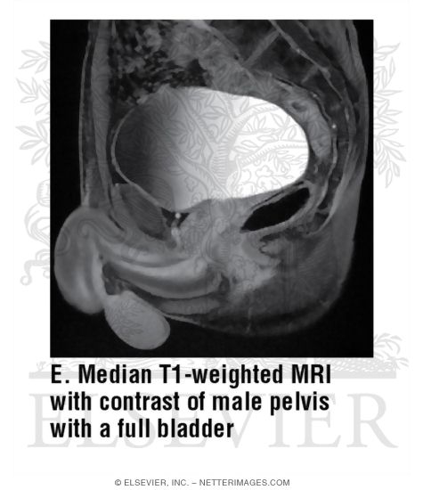 Watermarked preview of unlabeled image: Median T1-Weighted MRI With Contrast of Male Pelvis With a Full Bladder