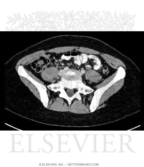 Axial CT With Soft Tissue Window Setting at Level of L5-S1