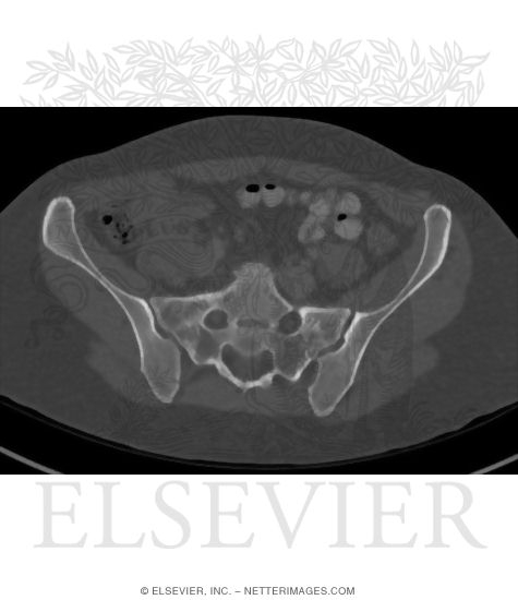 Axial CT With Soft Tissue Setting at Level of S1-S2 With Bone Window Setting