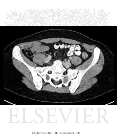 Axial CT With Soft Tissue Setting at Level of S1-S2