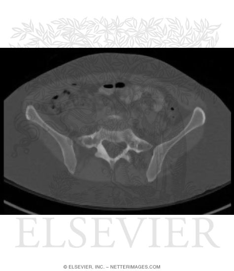 Axial CT With Soft Tissue Window Setting at Level of L5-S1 With a Bone Window Setting