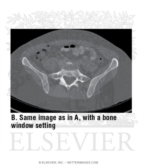 Axial CT With Soft Tissue Window Setting at Level of L5-S1 With a Bone Window Setting