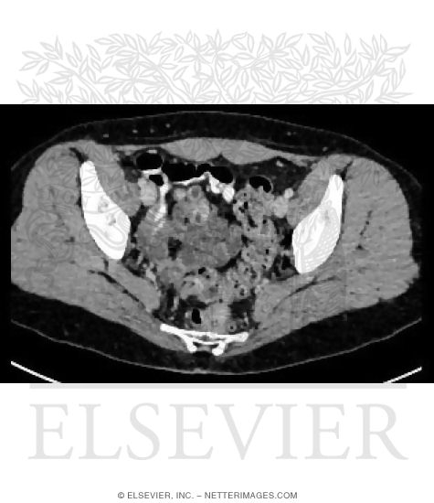 Axial CT With Diverticulum at Rectosigmoid Junction