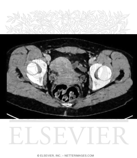 Axial CT of Lower Female Pelvis