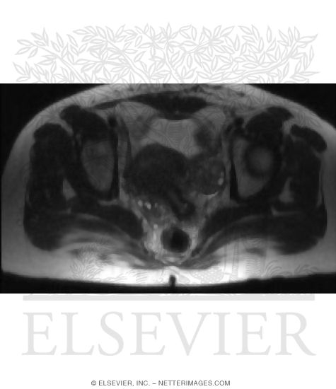 T2-Weighted MRI of Lower Female Pelvis