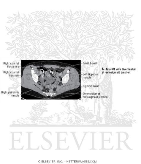 Axial CT With Diverticulum at Rectosigmoid Junction