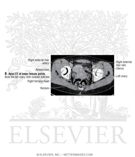 Axial CT of Lower Female Pelvis