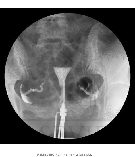 Hysterosalpingogram