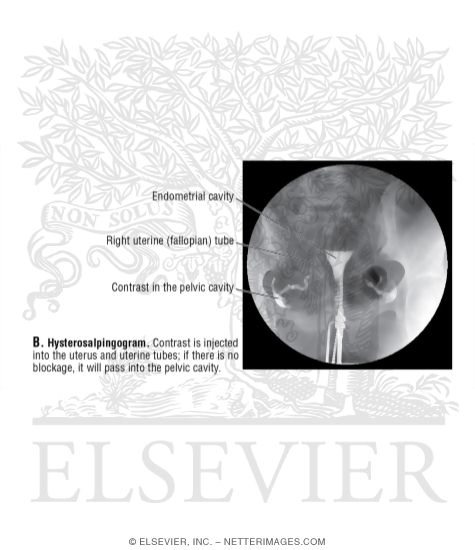 Hysterosalpingogram