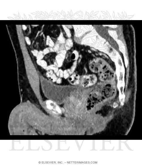 Male (Midsagittal) CT