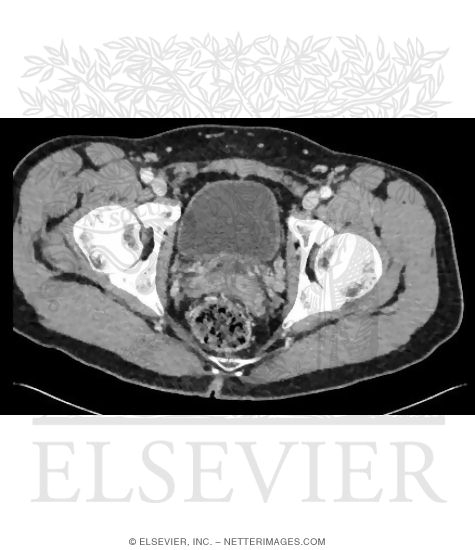 Male Axial CT at Level of Femoral Heads
