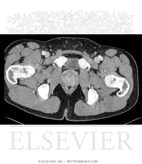 Watermarked preview of unlabeled image: Male Axial CT at Level of Greater Trochanters