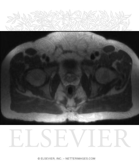 Watermarked preview of unlabeled image: T2-Weighted MRI Showing Prostate Gland Detail