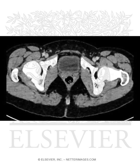 Axial CT Through Female Urinary Bladder