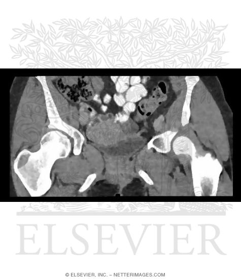Watermarked preview of unlabeled image: Coronal CT Through Female Urinary Bladder