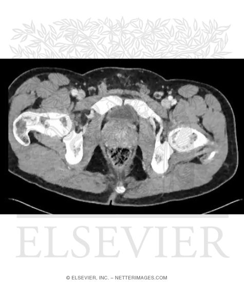 Axial CT Through Male Urinary Bladder