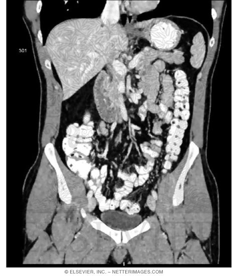 Watermarked preview of unlabeled image: Coronal CT Through Male Urinary Bladder