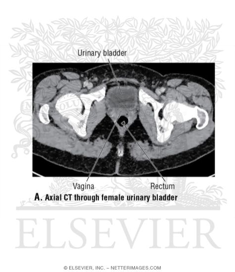Axial CT Through Female Urinary Bladder