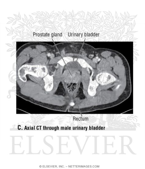 Axial CT Through Male Urinary Bladder