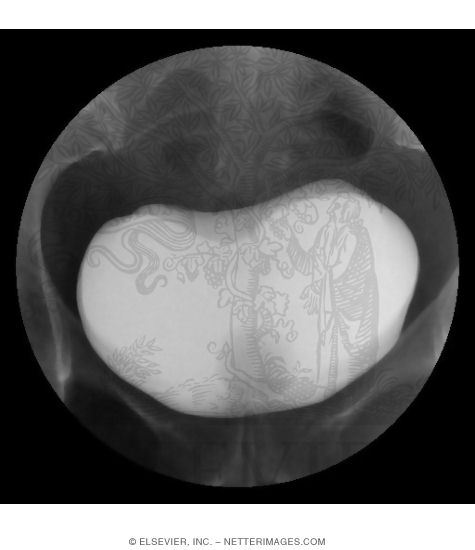 A Normal Routine Cystogram