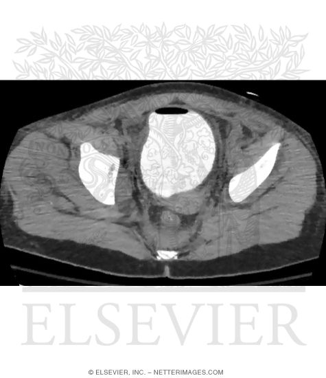 Watermarked preview of unlabeled image: CT Cystogram