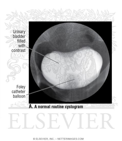 A Normal Routine Cystogram