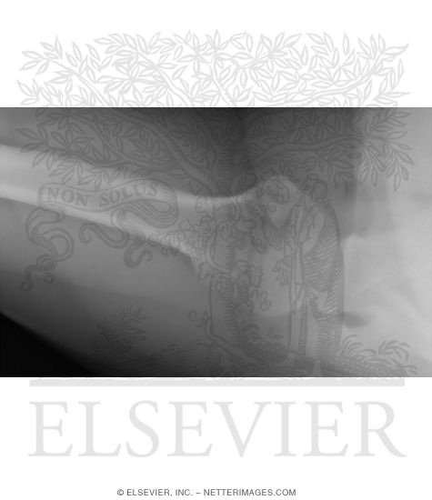 Watermarked preview of unlabeled image: Shoulder: Axillary View From Above