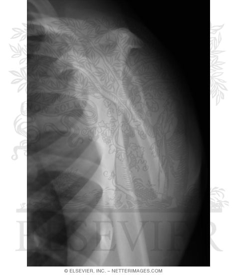 Y View of the Shoulder With X-Ray Beam Parallel to Scapular Blade