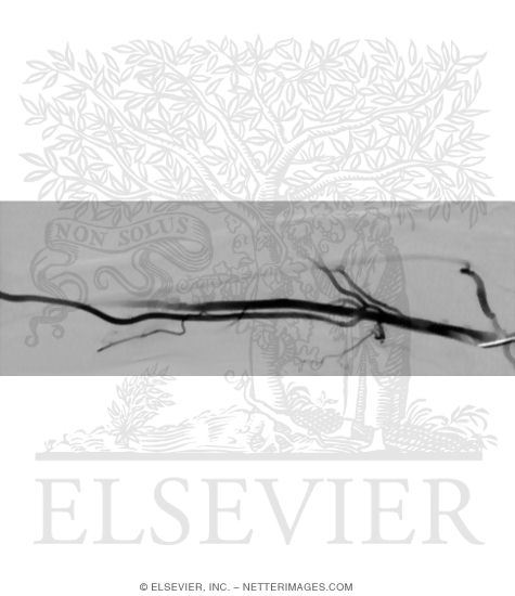 Digital Subtraction Angiography (DSA) of Axillary and Brachial Arteries