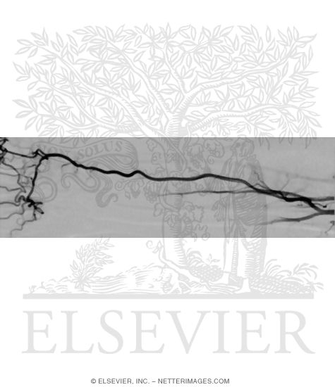 Watermarked preview of unlabeled image: Digital Subtraction Angiography (DSA) of Arteries of Forearm and Hand