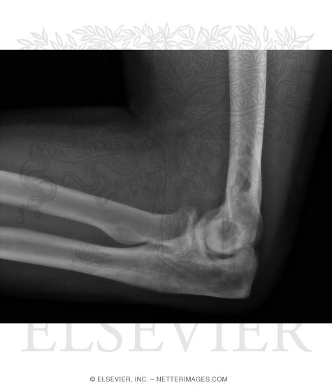 Lateral Radiograph of the Elbow