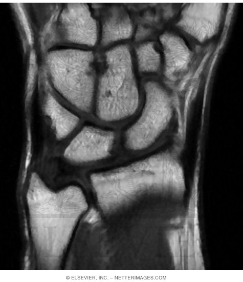 Coronal T1 MRI Through Wrist Joint