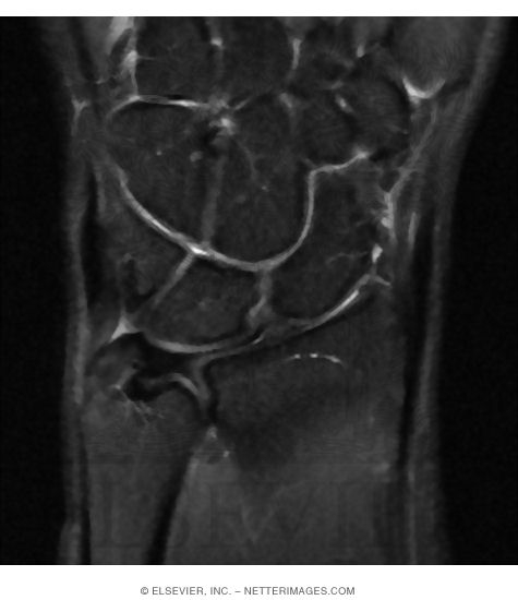 Watermarked preview of unlabeled image: Coronal T2 MRI Through Wrist Joint