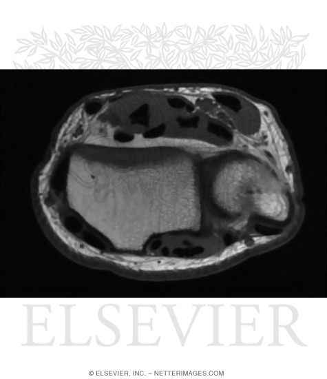 Watermarked preview of unlabeled image: Axial T1 MRI Through Distal Radioulnar Joint of Wrist