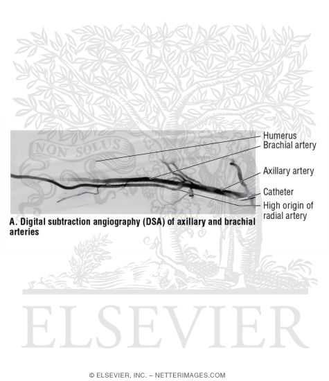 Digital Subtraction Angiography (DSA) of Axillary and Brachial Arteries
