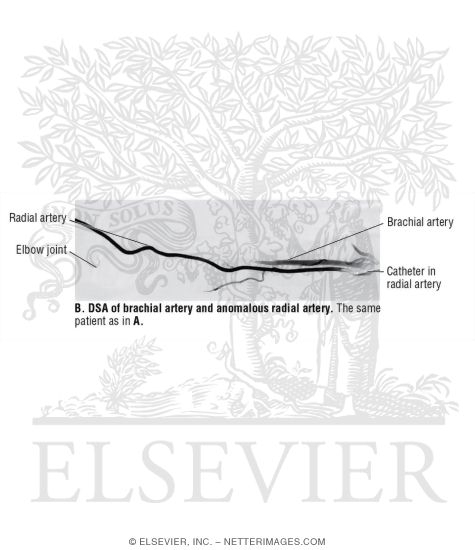 Digital Subtraction Angiography (DSA) of Brachial Artery and Anomalous Radial Artery
