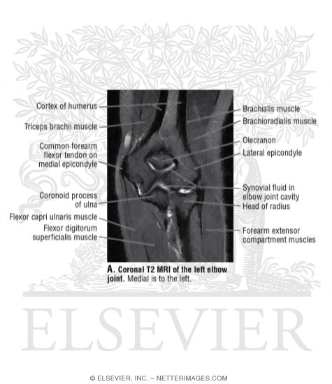 Coronal T2 MRI of the Left Elbow Joint