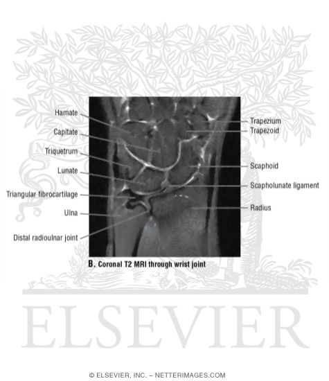 Coronal T2 MRI Through Wrist Joint