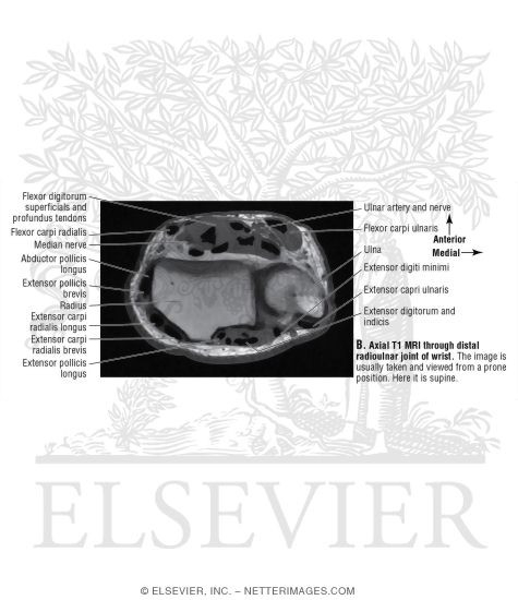 Axial T1 MRI Through Distal Radioulnar Joint of Wrist