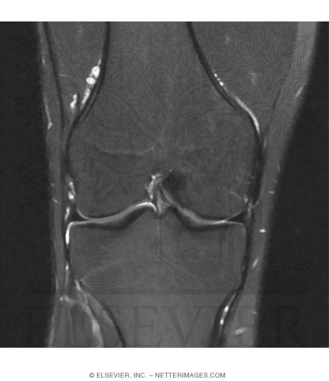 Coronal T2 MRI of the Knee Joint