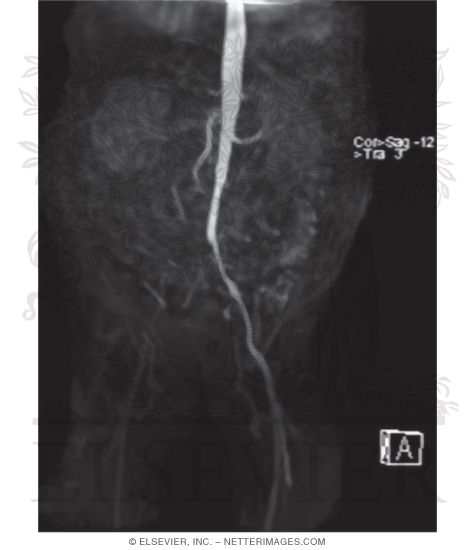Watermarked preview of unlabeled image: MRA With Maximum Intensity Projection (MIP) Showing Complete Occlusion of the Right Common and External Iliac Arteries Caused By Atherosclerosis