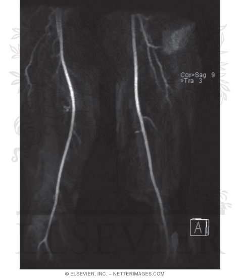 Watermarked preview of unlabeled image: MRA With Maximum Intensity Projection (MIP) of Relatively Normal Profunda Femoris, (Superficial) Femoral, and Popliteal Arteries