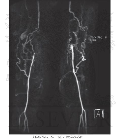 Watermarked preview of unlabeled image: MRA With Maximum Intensity Projection (MIP) Showing Occlusion of Distal (superficial) Femoral Arteries Bilaterally