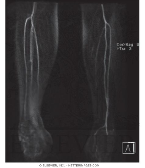 MRA With MIP Showing Occlusion of Left Posterior Tibial Artery