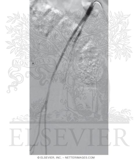 Watermarked preview of unlabeled image: DSA of Common Iliac, External Iliac, (Common) Femoral, Profunda Femoris, and (Superficial) Femoral Arteries In Female Patient