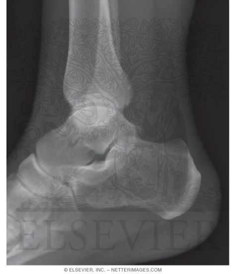 Lateral X-Ray of the Ankle