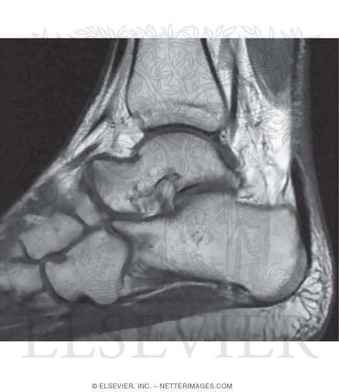 Watermarked preview of unlabeled image: Sagittal T1 MRI Through the Ankle Joint